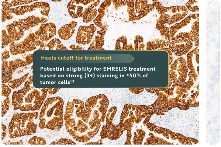 Microscopic view of tumor cells showing high met IHC stain