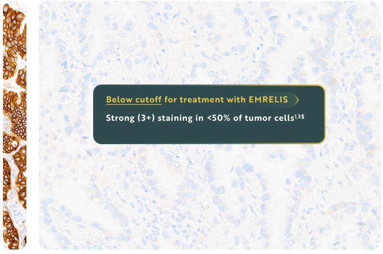 Microscopic view of tumor cells showing low met ICH stain